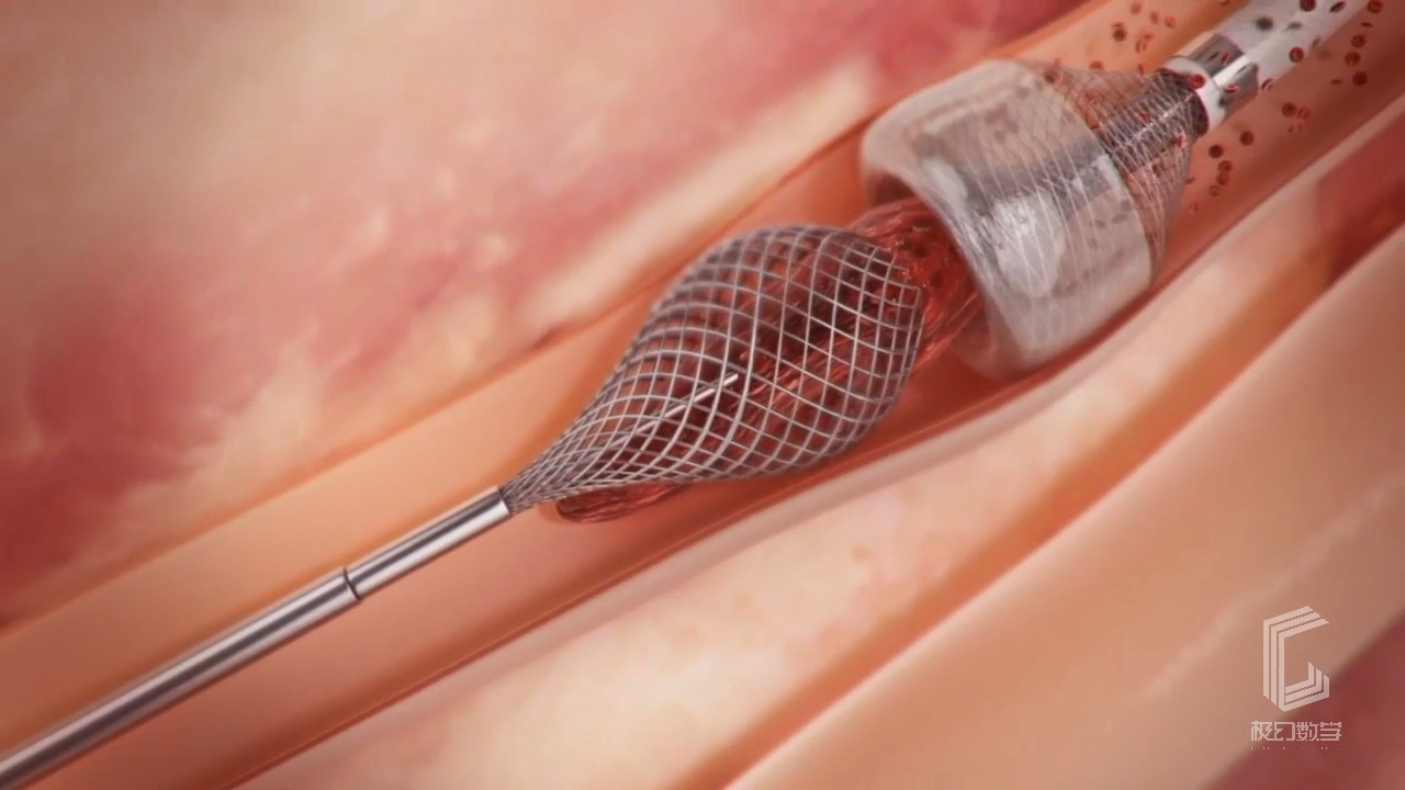 心脏支架手术全过程-医疗动画展示片