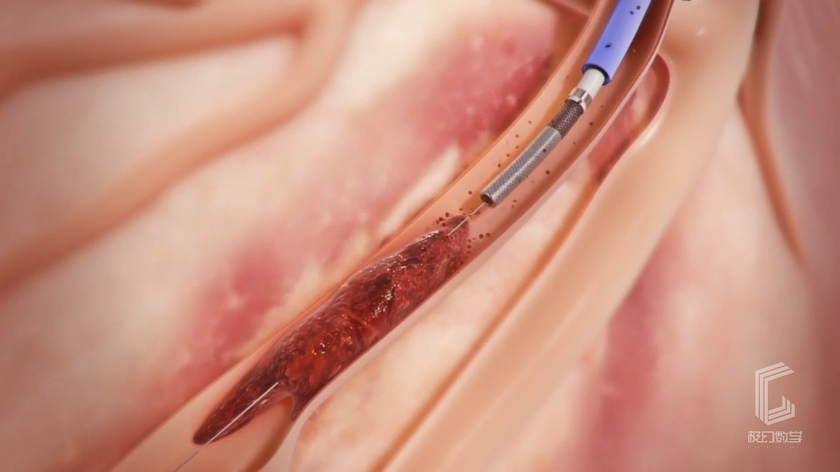 心脏手术支架手术过程动画